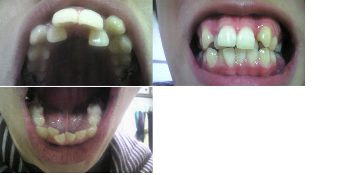 美容 歯並びガタガタ 叢生 で悩んでるヤツ集合 美容2chまとめブログ