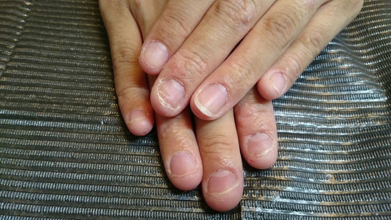 「爪噛み症」なぜ噛んでしまうのか？…皮膚科医・小児科医と考える　「爪噛みは親の愛情不足」は迷信