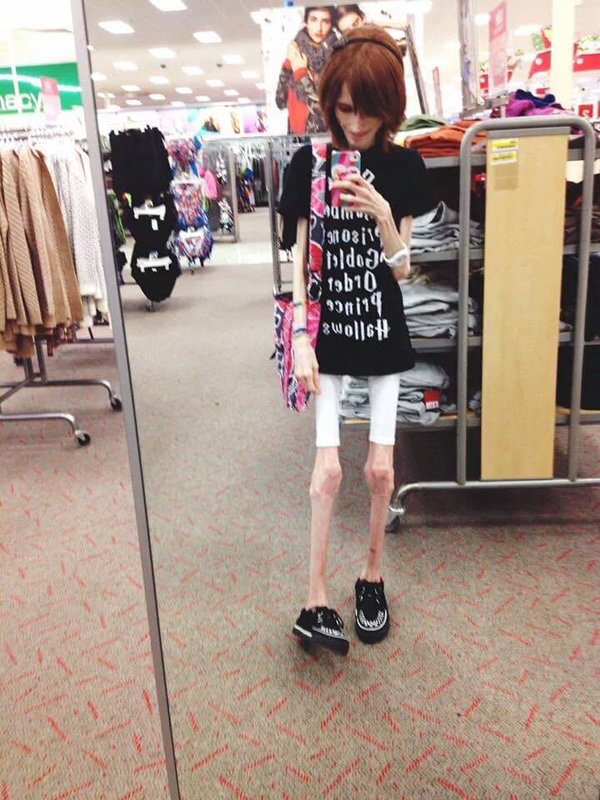 ガリガリ過ぎる女性が話題に どうやって立ってるの コラでは との声 ブラック速報 ガリガリ過ぎる女性が話題に どうやって立ってるの コラでは との声 ブラック速報