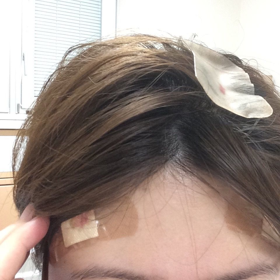 脳腫瘍が発覚後 生検術をしまして 24歳で脳腫瘍になりまして