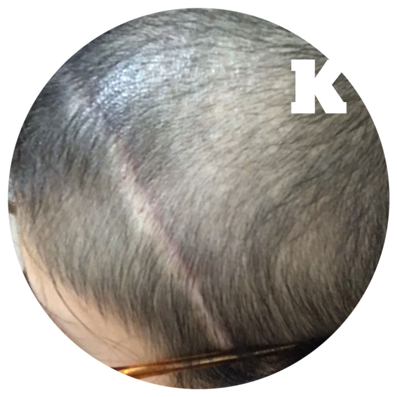 退院後 ３ヶ月後の髪の毛の状態 24歳で脳腫瘍になりまして