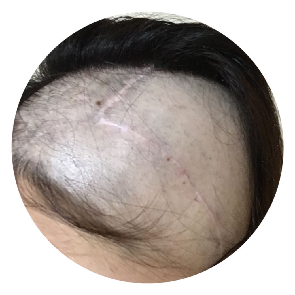 退院後の髪の毛の状態 4ヶ月後の状態 24歳で脳腫瘍になりまして