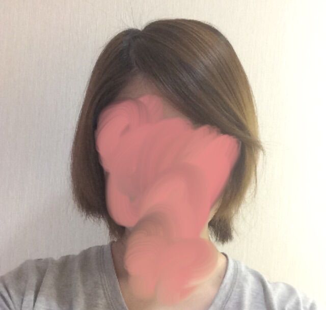 退院直後の髪の毛の状態 24歳で脳腫瘍になりまして