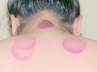 cupping_after