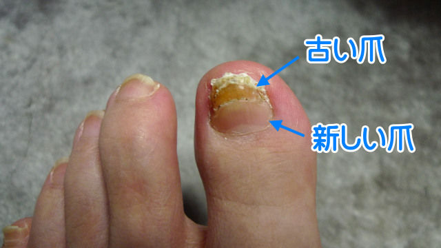 足の爪が生え変わり中 ぼころぐ 足の爪が生え変わり中 ぼころぐ