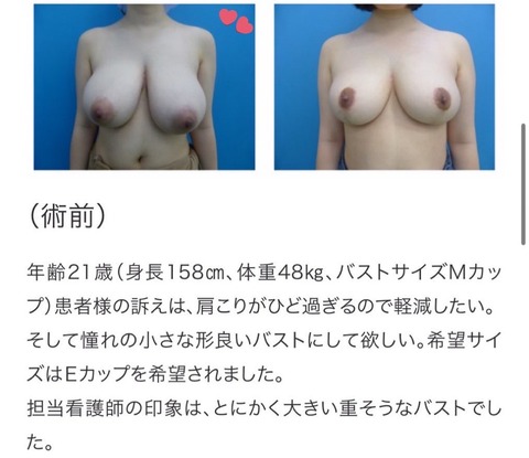 【画像】Mカップのおっぱい、Eカップにされるｗｗ