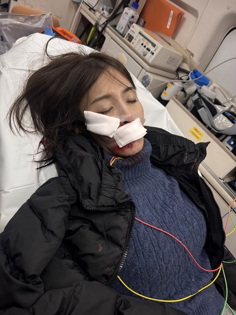【画像】熟女AV女優さん、顔を13針縫う大怪我をしていた