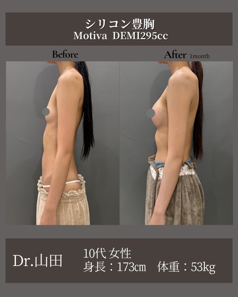 173cm/53kgの10代女性、A→Dカップへシリコン豊胸