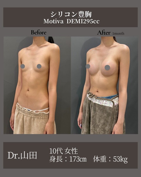 173cm/53kgの10代女性、A→Dカップへシリコン豊胸