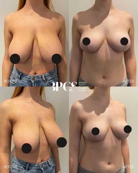【画像】垂れ乳、手術でアップデートされてしまうшшшшшшшшшшшш