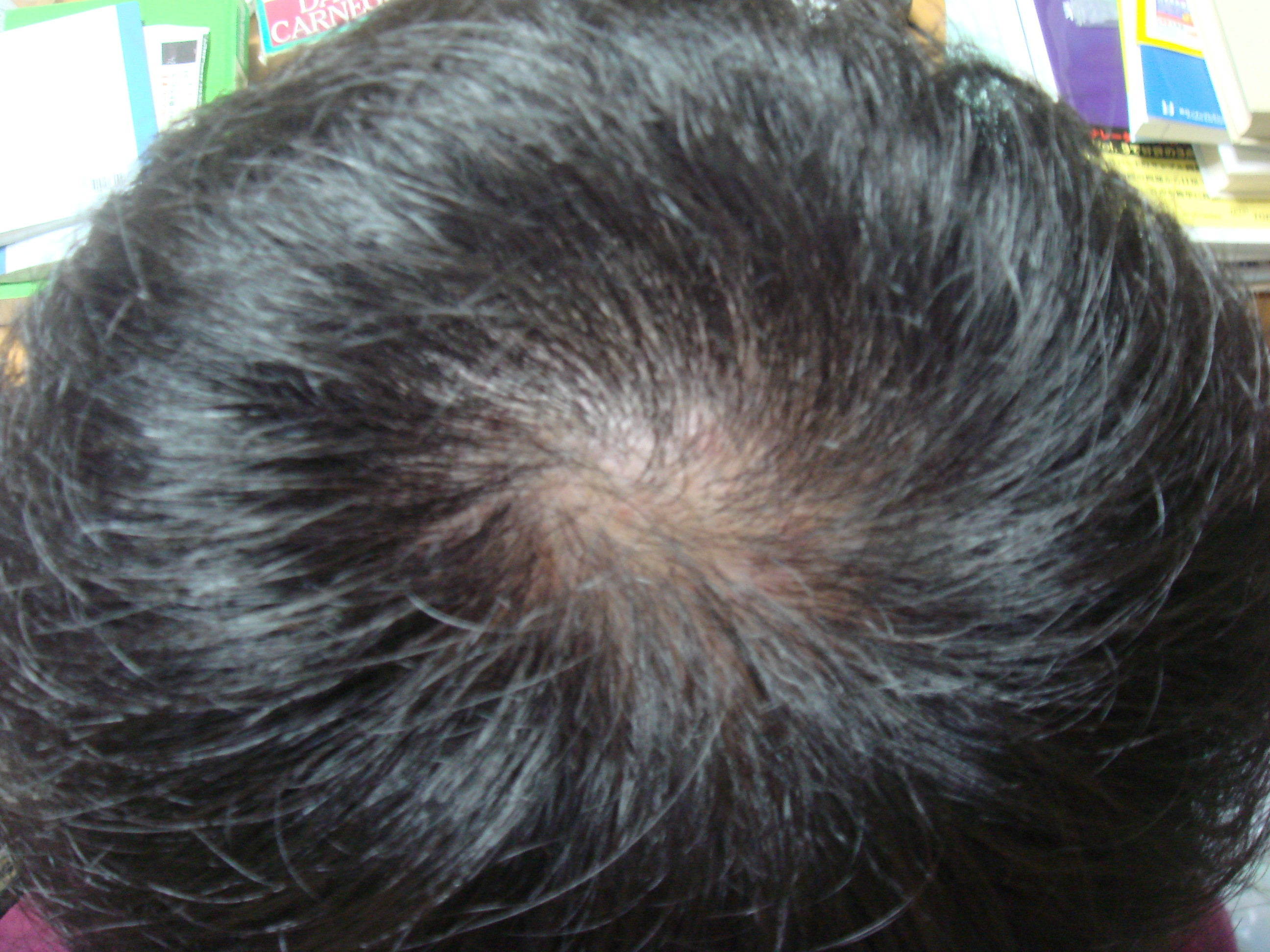 頭のてっぺん Bosque67のblog