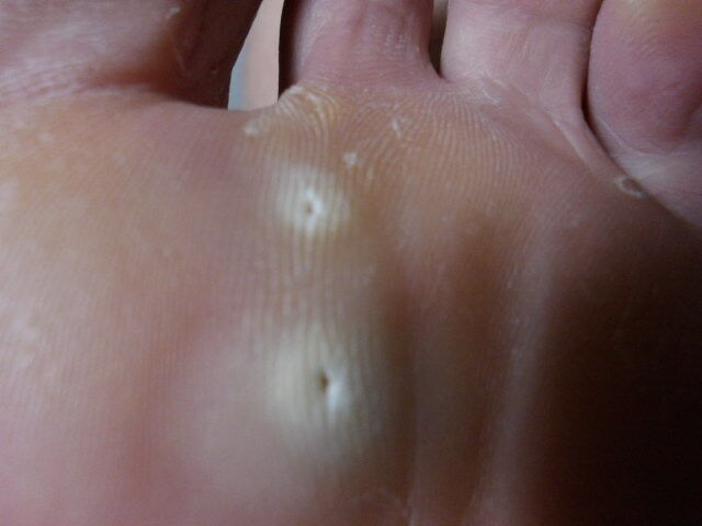 魚の目 の痛み発症 素人登山家の山行記録 魚の目 の痛み発症 素人登山家の山行記録