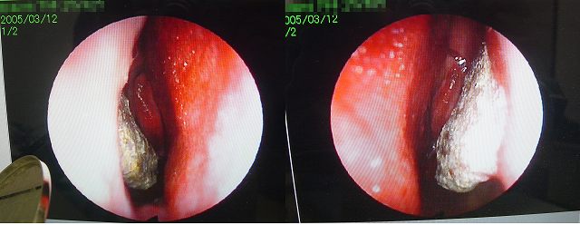 花粉症でお困りの方 B級博士の俺の話を聞け