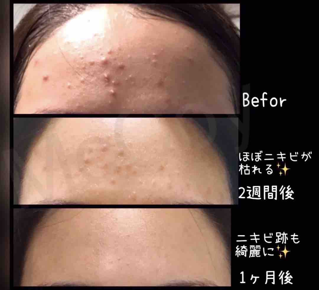 マクセリーピケ使ってみての感想 : エステサロン・ブランシェ ...