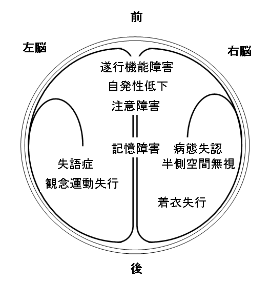 脳祭 画像所見をどう考える 必要とされるセラピストになるために Bridge小松の臨床感とセミナー案内