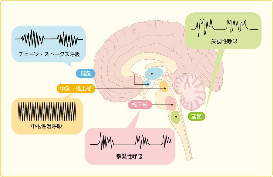 ヘルニア と は 脳