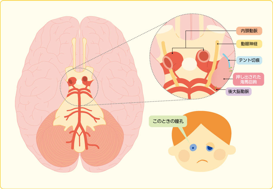 くも膜下出血の対応 ６ ぶーぶー 昔ドラマー今 ｍｒ ドローン