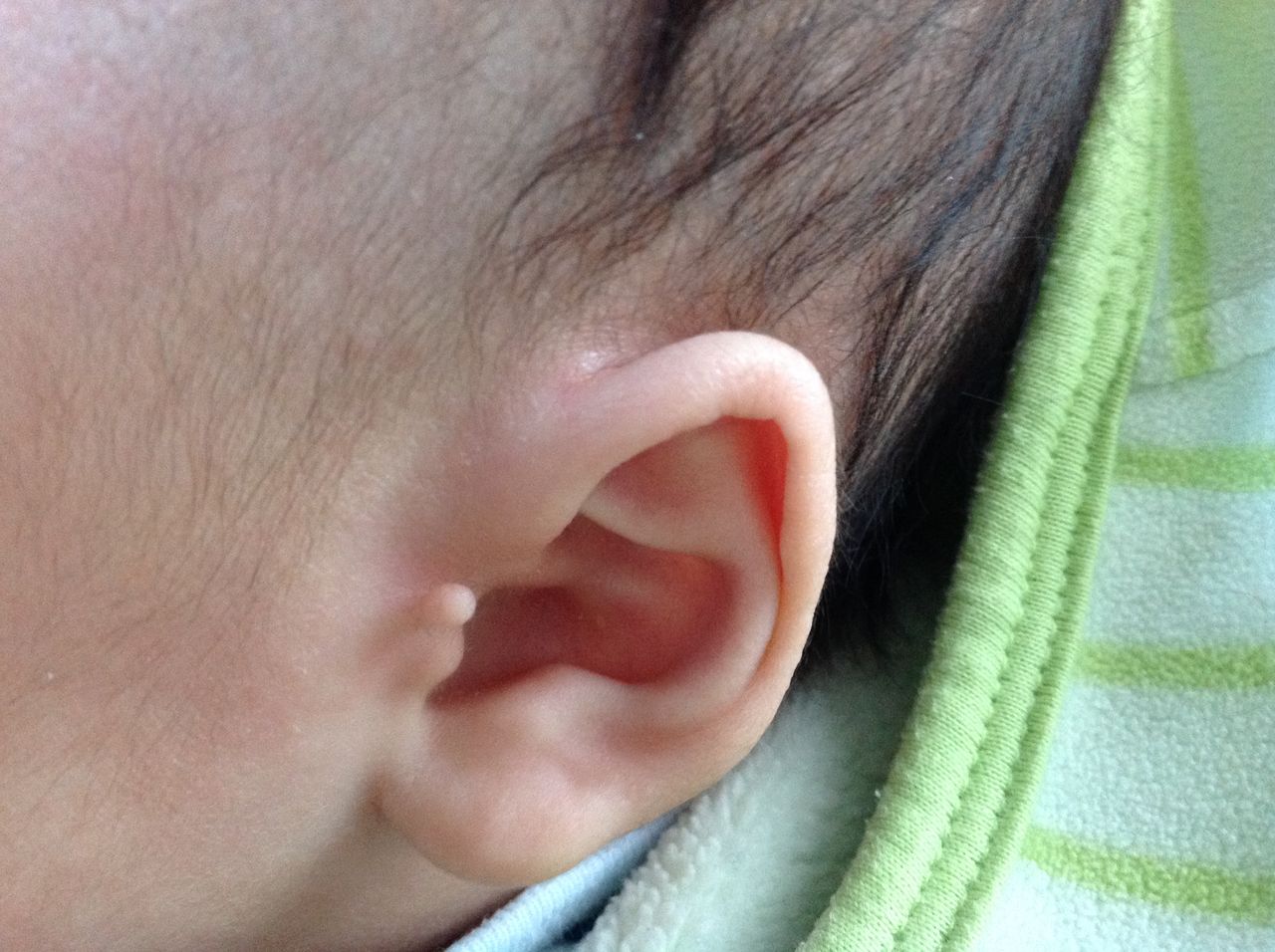 副耳 耳の腫瘍 Cabbagetaroのblog