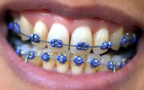 Fack_braces_trend