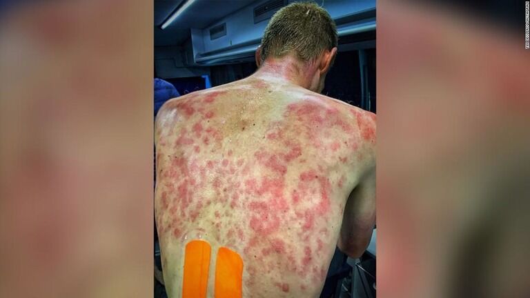 大きな ひょう が自転車レース中の選手を直撃 背中などにミミズ腫れ被害 フランス News Car Multi Information