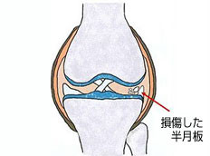 半月板損傷