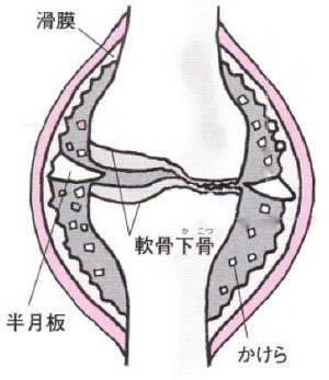 hizakansetsushou