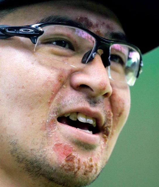 會澤翼_護摩行_火傷