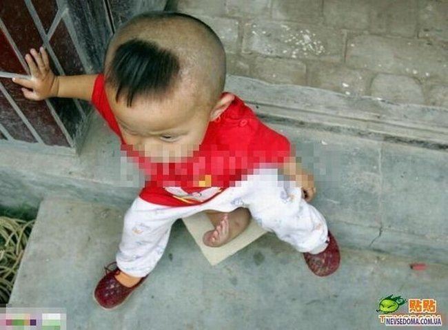 奇形 三本の足を持つ中国の男の子 手術に成功する 付録部 Blog Bu 奇形 三本の足を持つ中国の男の子 手術に成功する 付録部 Blog Bu