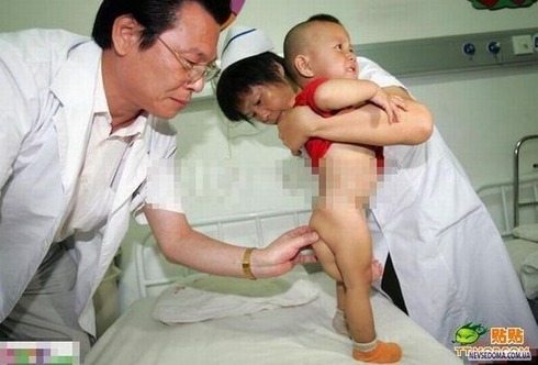 Chinese_doctors_remove_babys_third_arm_5