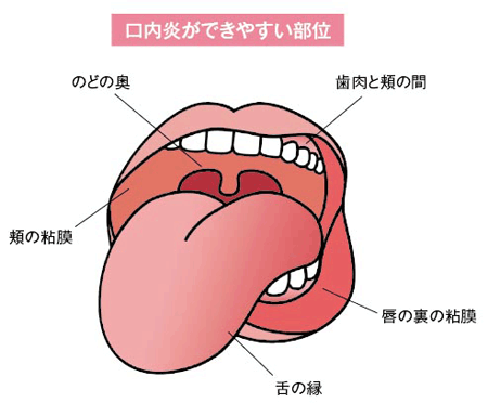 口内炎ができた時どうしてる？