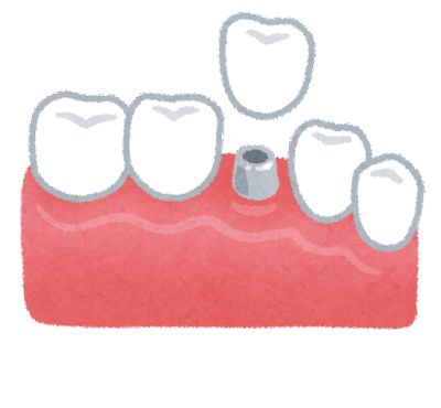 teeth_implant