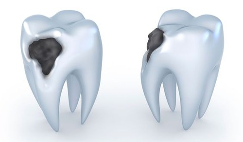 虫歯放置してたら割れた