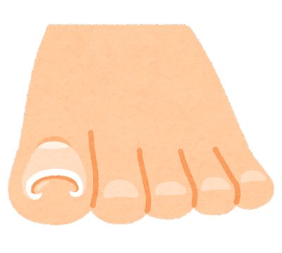 【悲報】足の巻き爪、歩くだけで血だらけになるし痛すぎる