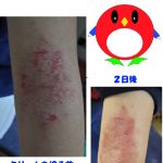 長男の肌の経過-20170413