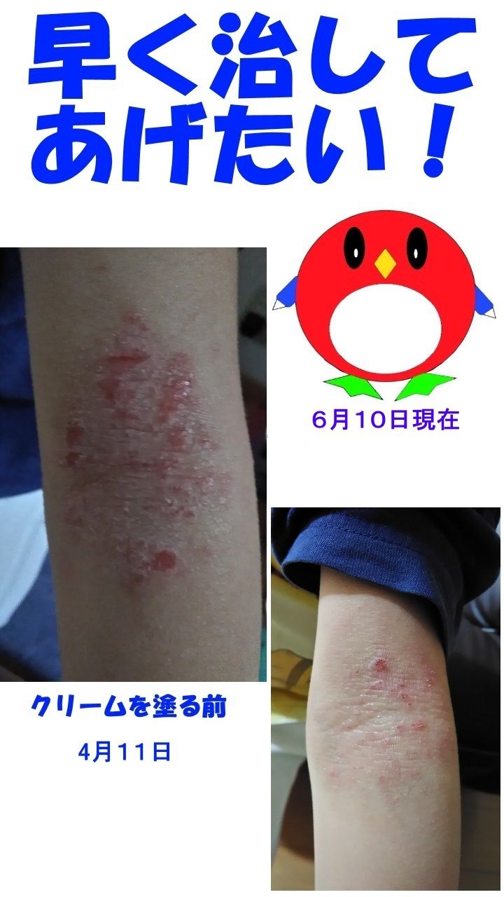 長男の肌が良くなってきましたよ!