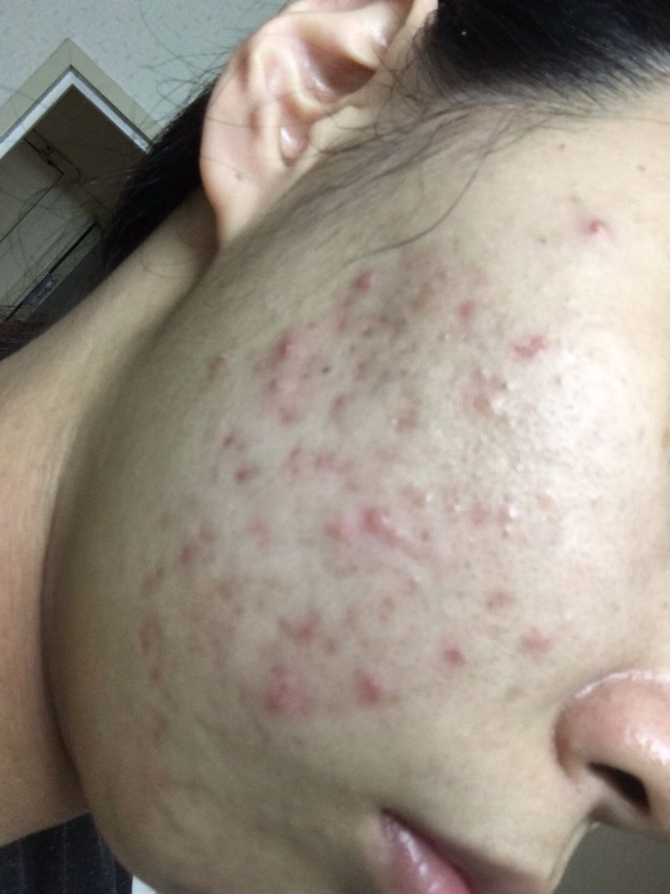 ニキビが治った クロロフイル心斎橋美顔 ニキビが治った クロロフイル心斎橋美顔
