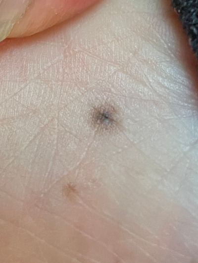 2025-02-22-skincancer2