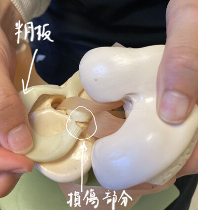 2023-01-04-meniscus1