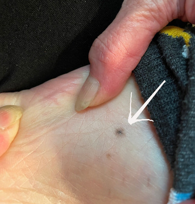 2025-02-22-skincancer1