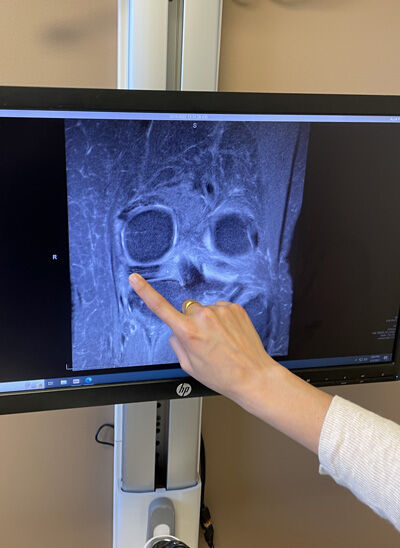 2023-01-04-meniscus2