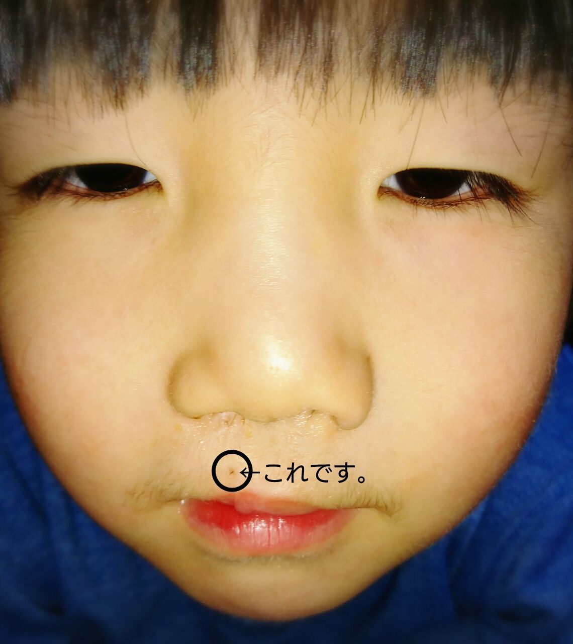 一人の女性との繋がり お口のお話し 口唇口蓋裂