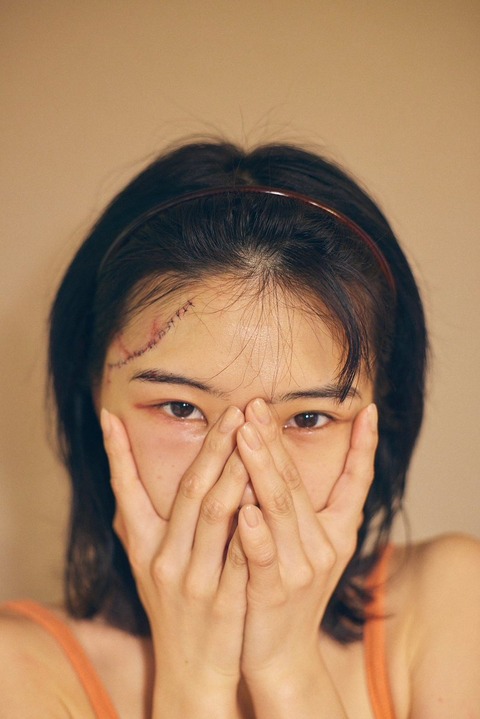 【闇深】BiSHアイナ・ジ・エンドさん、MV撮影中の事故でおでこを30針縫う大ケガ!