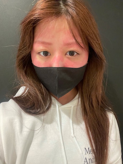 【衝撃】AKB48吉橋柚花さん、眉毛を染めてアレルギーでとんでもない顔になってしまう
