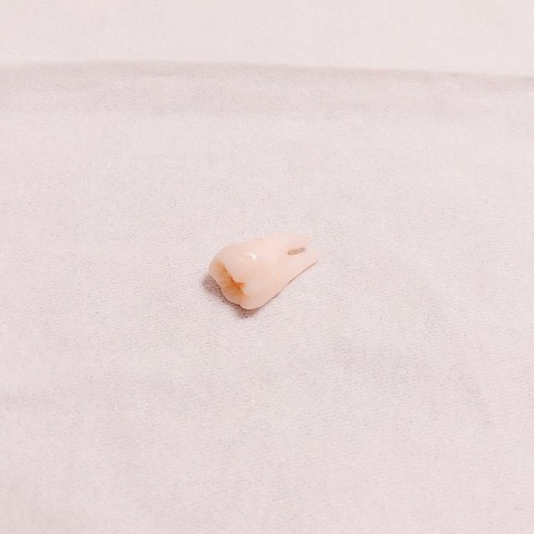 【画像】現役アイドルの抜歯された「歯」がコチラ【NMB48・川上礼奈】