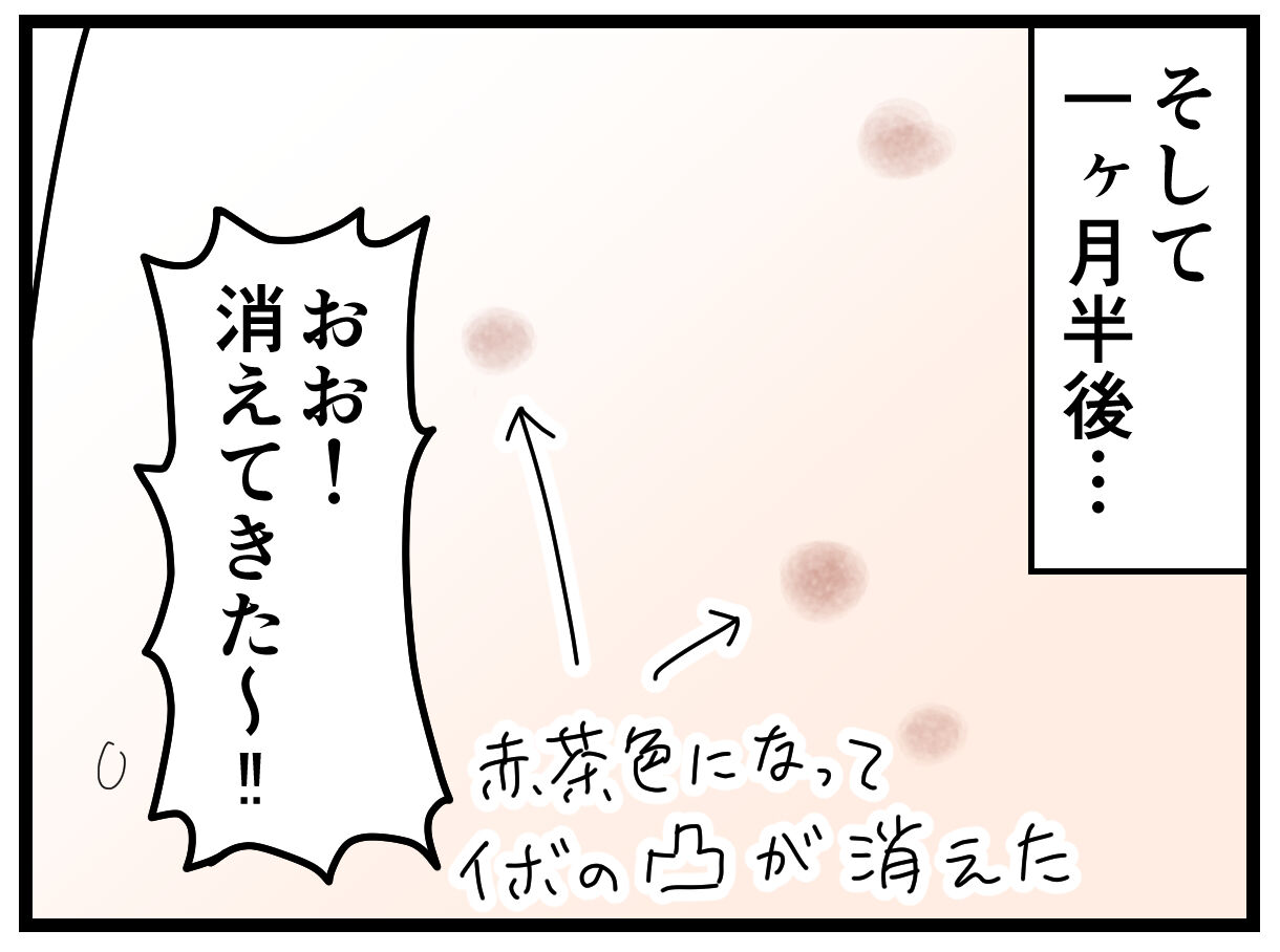 3A M-BF CREAM たわい 水イボ 水いぼクリーム