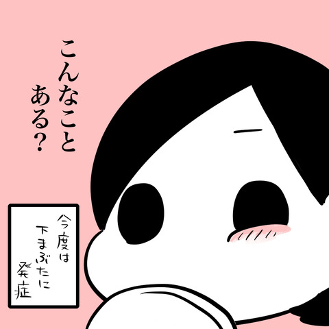 結膜炎4