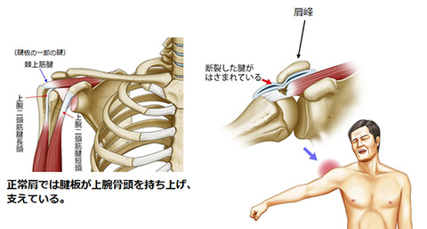 rotator-cuff-injury_01_03