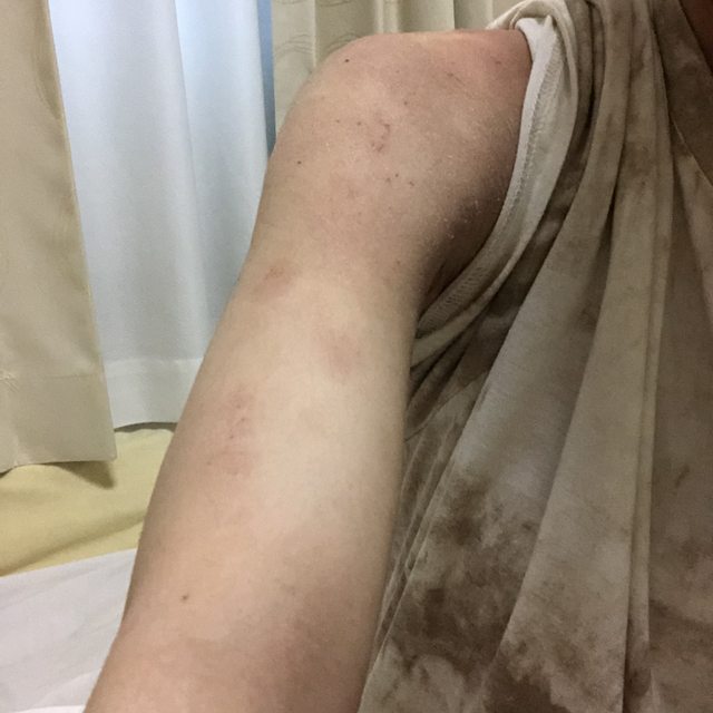 閲覧注意 アトピーの女だけど地獄すぎてワロタ ごらんください チョコの株式投資diary