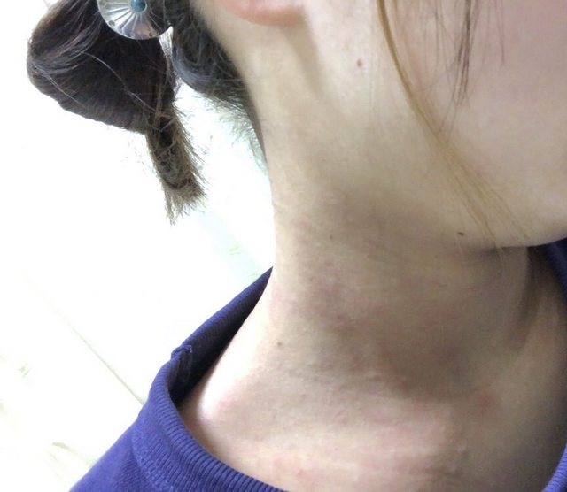 閲覧注意 アトピーの女だけど地獄すぎてワロタ ごらんください チョコの株式投資diary