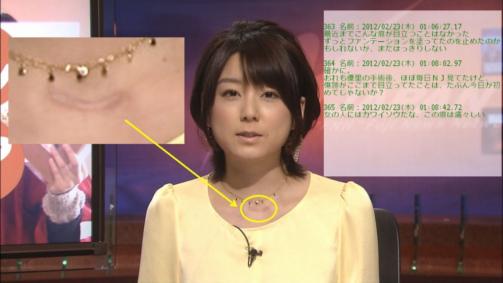 深頚部膿瘍(拡大表示)